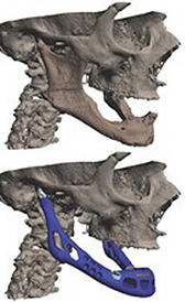 Imagen de implante mandibular