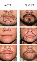 Implante de barba, bigote y cejas