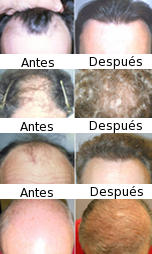 Reducción del cuero cabelludo