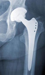 Implante de cadera