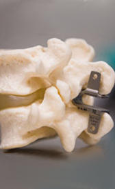 Imagen de implante interespinoso coflex