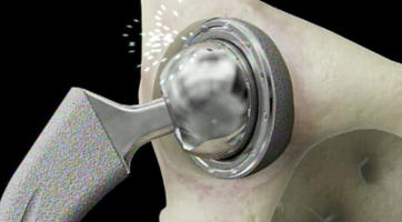 Riesgos de los implantes de cadera
